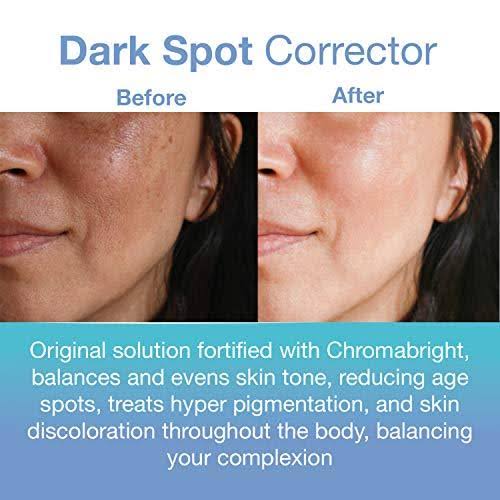 Dark Spot Remover Skin Care Treatment T8149